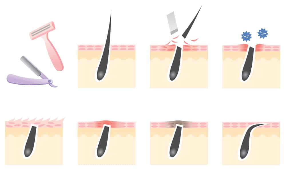 Ingrown Hair How It Happens